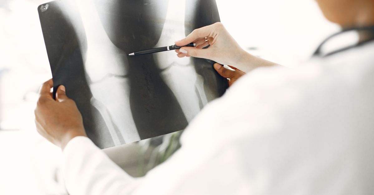 Innovative Approaches to Osteoporosis Treatment: What You Need to Know